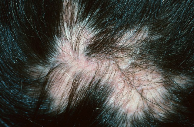  Alopecia on Causes Of Hair Loss    Madhupriya S Blog